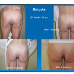 Photos "avant / après intervention avec un produit utilisé en Amérique du Sud (PMMA)", issues de la présentation de MS Serra, au 6e Workshop sur les lipodystrophies, qui se tenait à Washington, en 2004